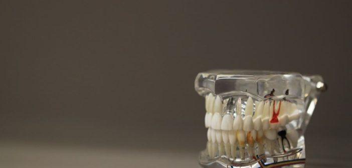 Зубные коронки: Виды и преимущества