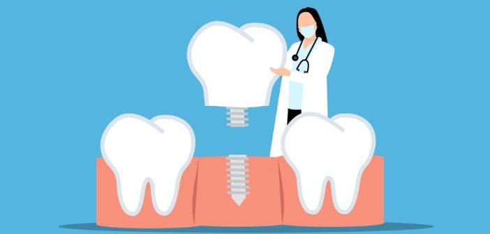 Имплантация зубов: Преимущества и основные виды