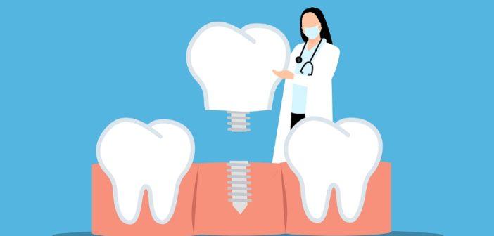Зубные коронки: Материалы изготовления и их преимущества