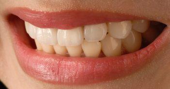 Виниры для зубов: Основные особенности и материалы изготовления